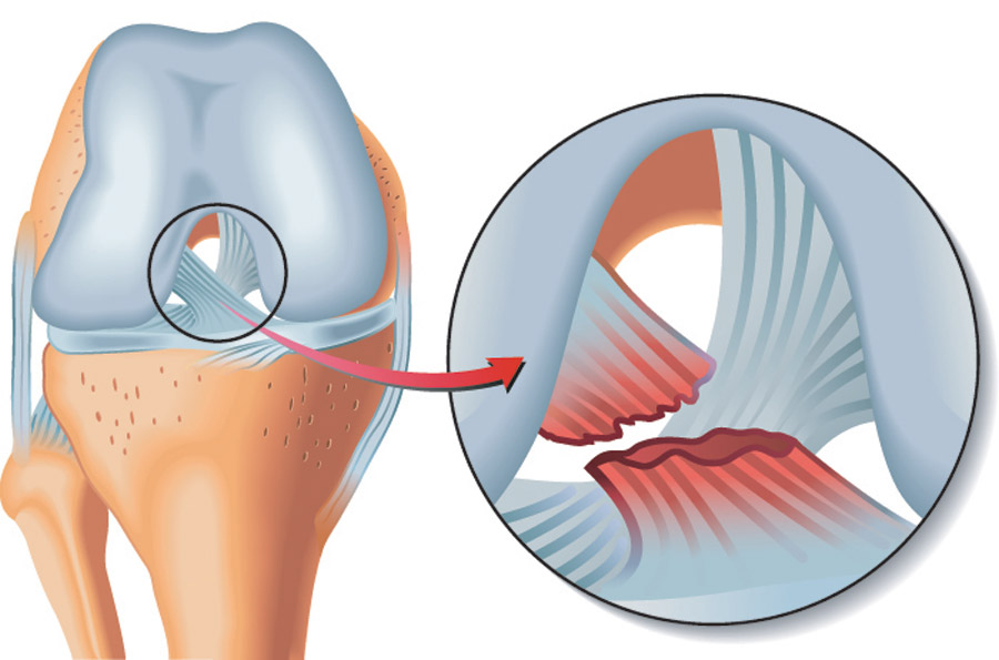 Everything That You Need To Know About Ligament Injury